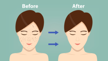 シルファームXはニキビ跡に効果ある？何回で変化が分かるのか解説！